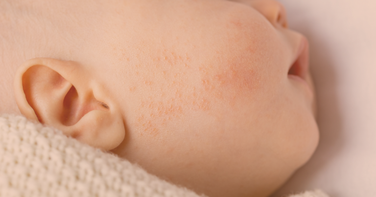 Réactions à l’histamine chez les bébés : comprendre les rougeurs après avoir manger de l’aubergine, de la fraise ..